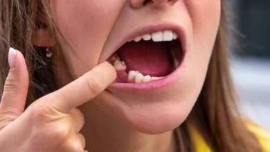 تفسير حلم كسر الضرس في المنام